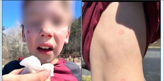 The two kids — ages 8 and 10 — shot by Peachtree City teens with splat guns were hit in the face and chest. Photos/Peachtree City Police Facebook.