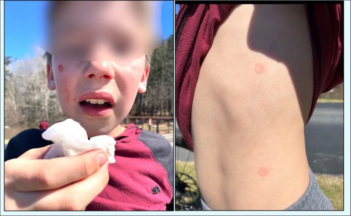 The two kids — ages 8 and 10 — shot by Peachtree City teens with splat guns were hit in the face and chest. Photos/Peachtree City Police Facebook.